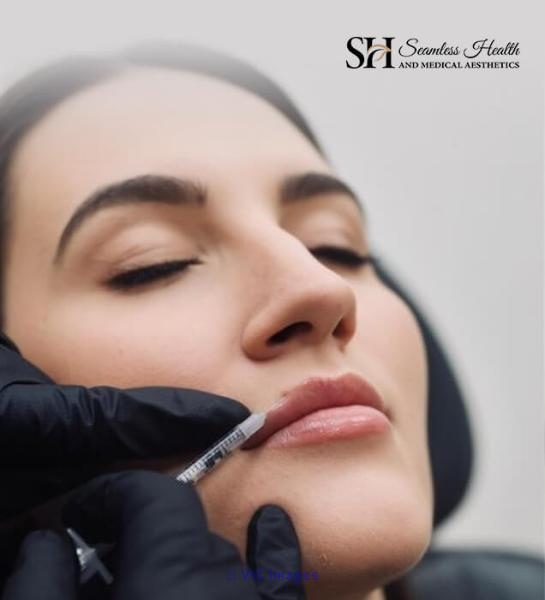 Lip Filler Treatment at Seamless Health in Ottawa - Photo 1